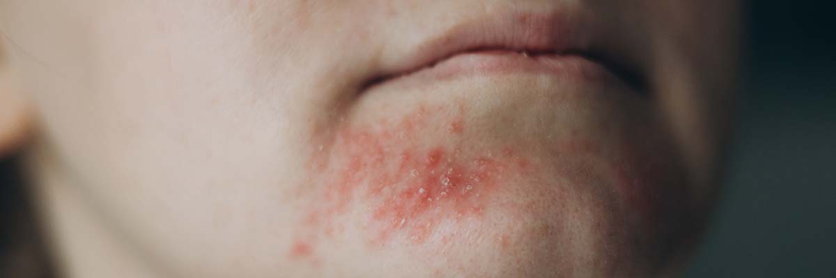 Flared Skin Dos and Don'ts