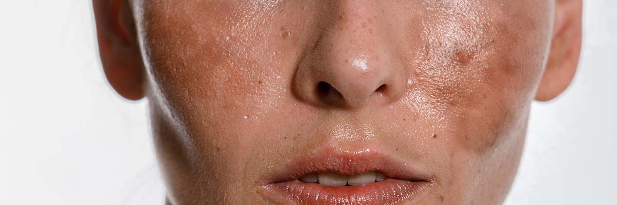 Hyperpigmentation Dos and Don’ts