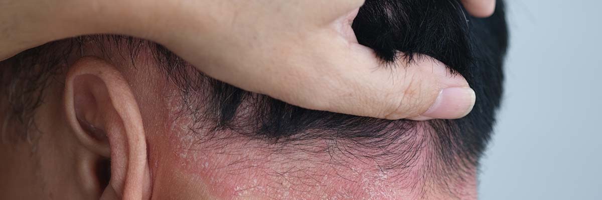 Psoriasis Dos and Don’ts