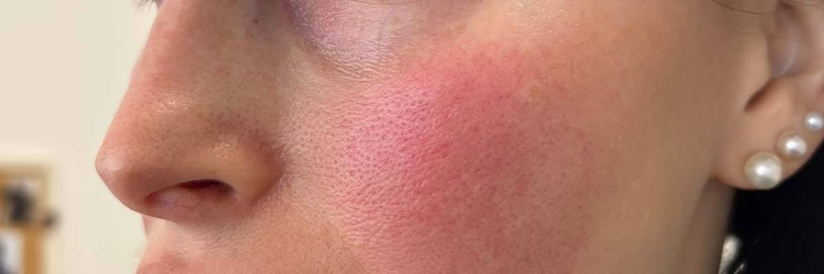 Living with Rosacea