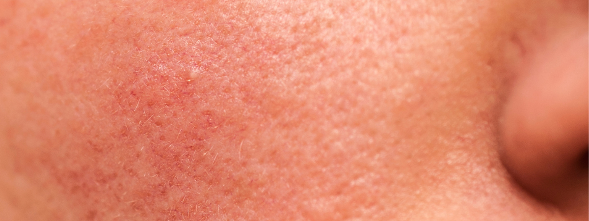 AMPERNA Sensitive Skin