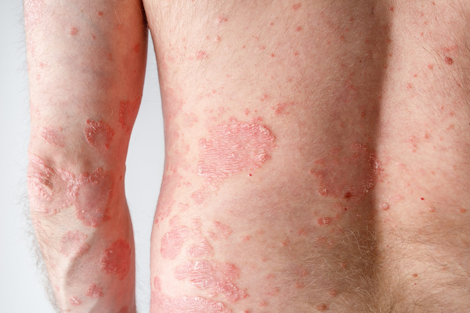 AMPERNA-Skin-Concerns-Psoriasis.jpg