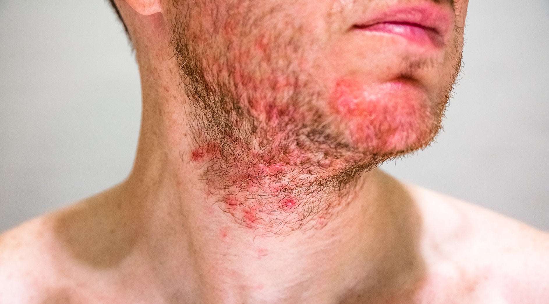AMPERNA-Skin-Concerns-Sebborheic-Dermatitis.jpg