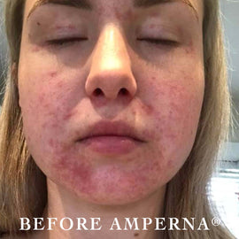 AMPERNA®