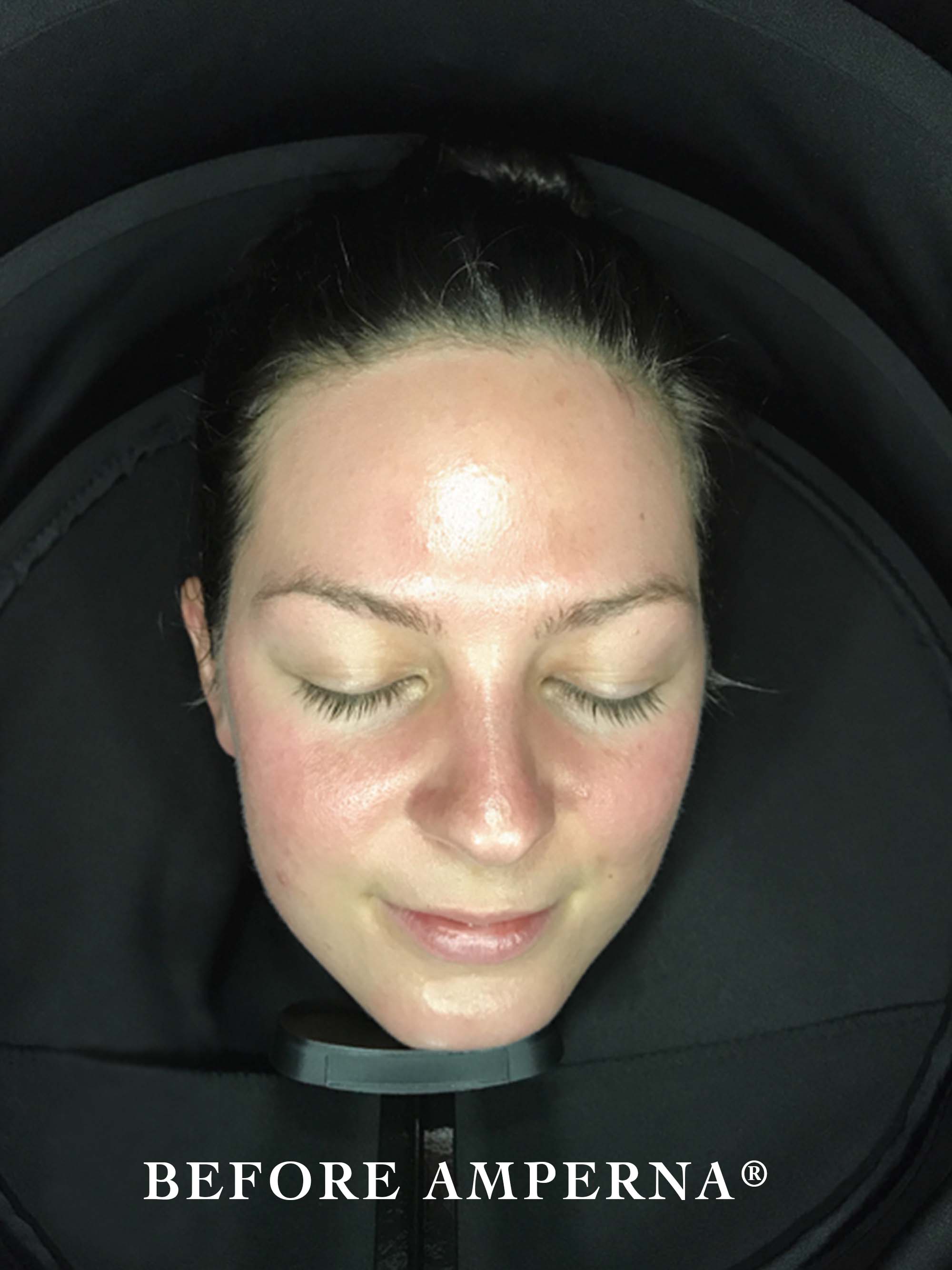 Amperna-pigmenation-before.jpg