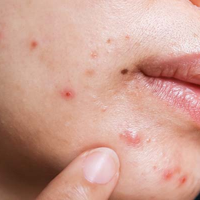 Amperna_anti-inflammatory_acne.png