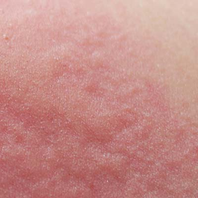 Sensitive_skin_affected_area.png
