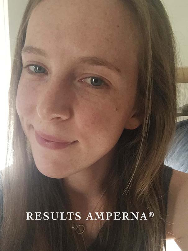 acne_after.jpg
