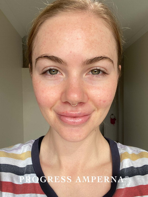 acne_after_leisa.jpg