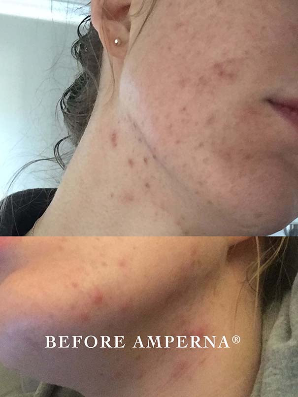 acne_before.jpg