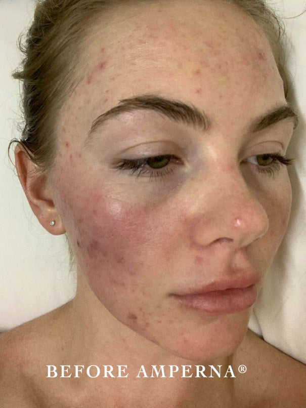 acne_before_leisa.jpg