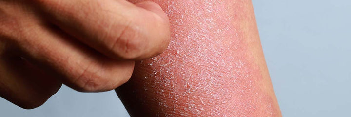 AMPERNA Eczema skin being scratched