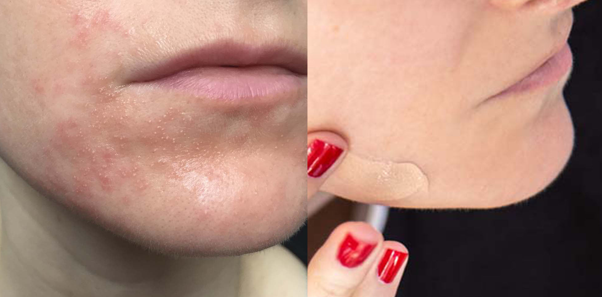 amperna_founder_perioral_dermatitis_before_after.jpg