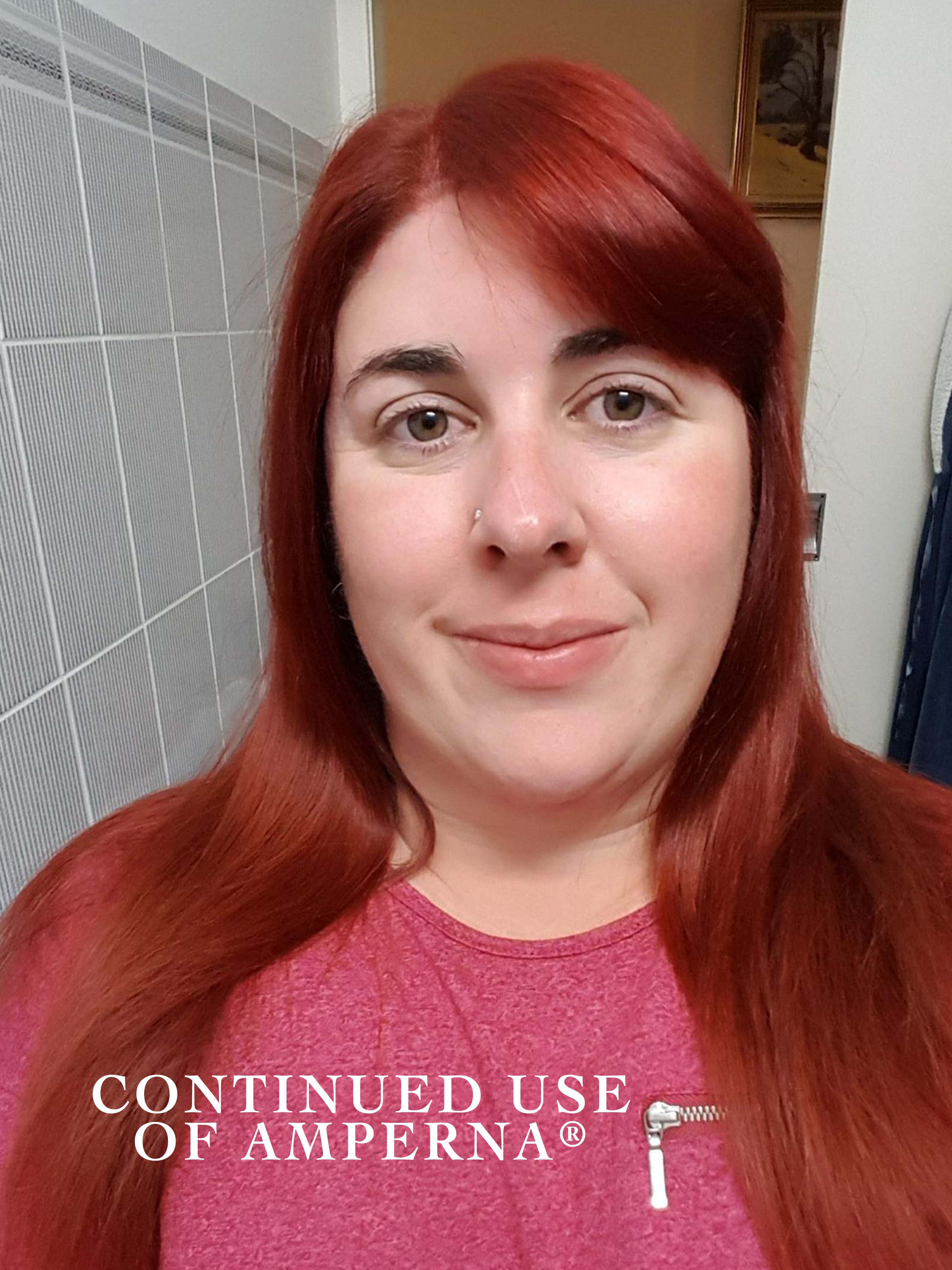 rosacea_after.jpg