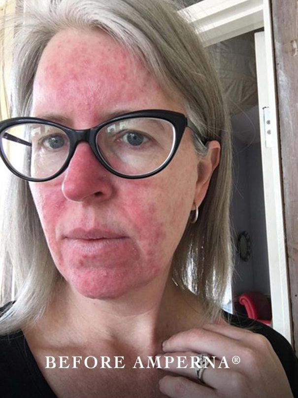rosacea_wanita_before.jpg